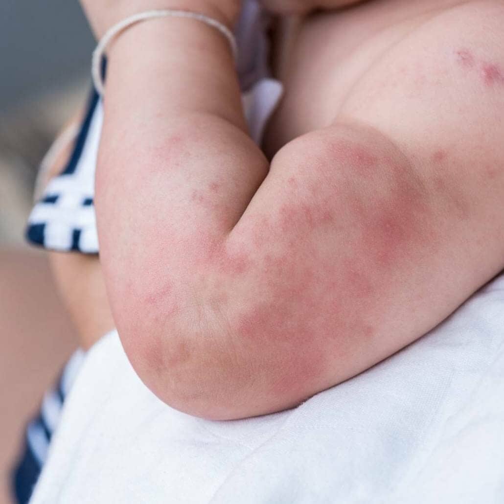 baby skin how oatmeal can relieve itchy baby skin