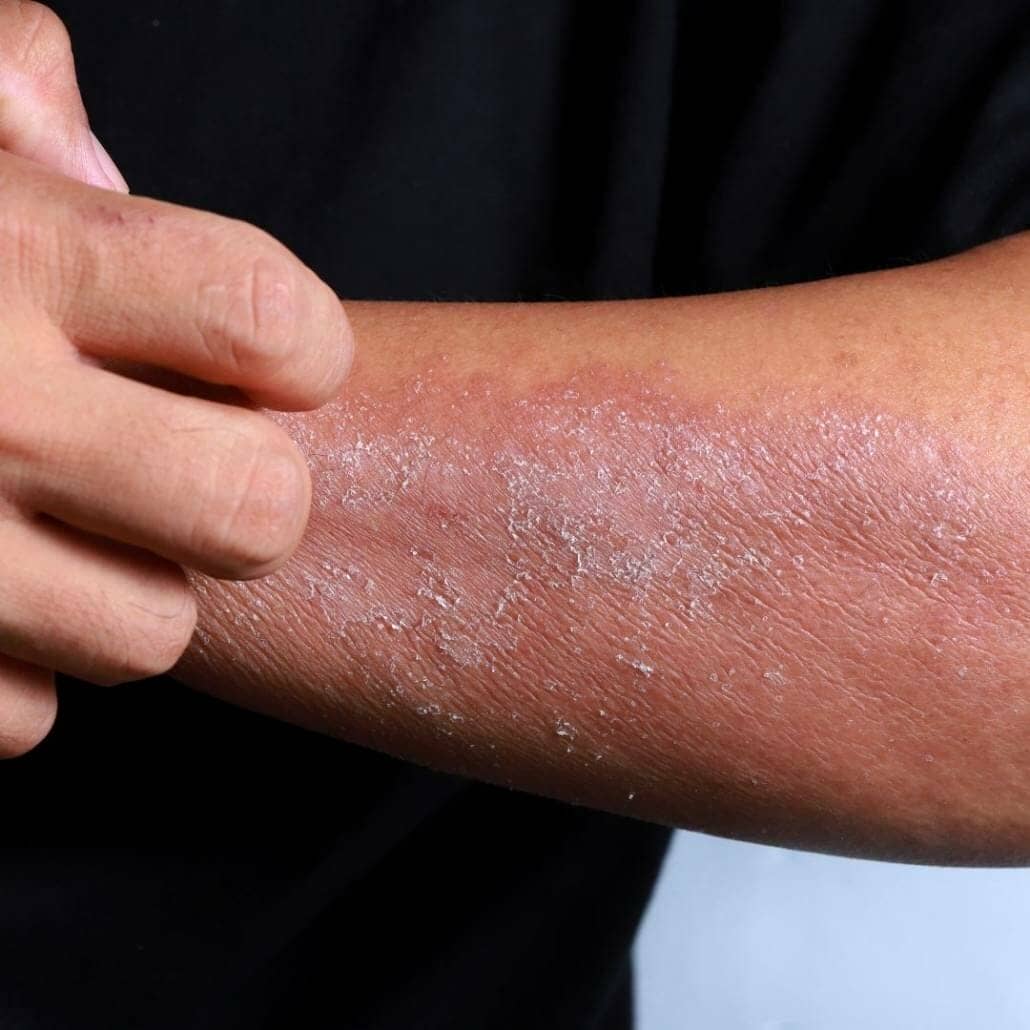 Eczema on arm 